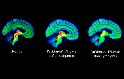 King's College London on LinkedIn: Brain scans reveal exactly why