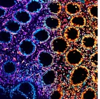 A section of the intestinal wall from a patient with Crohn’s disease, showing circular crypts surrounded by mesenchymal cells. The image is pseudocolored to show how ILC1 could mediate wound healing, but that this could tip towards cancer or fibrosis if the response is uncontrolled.