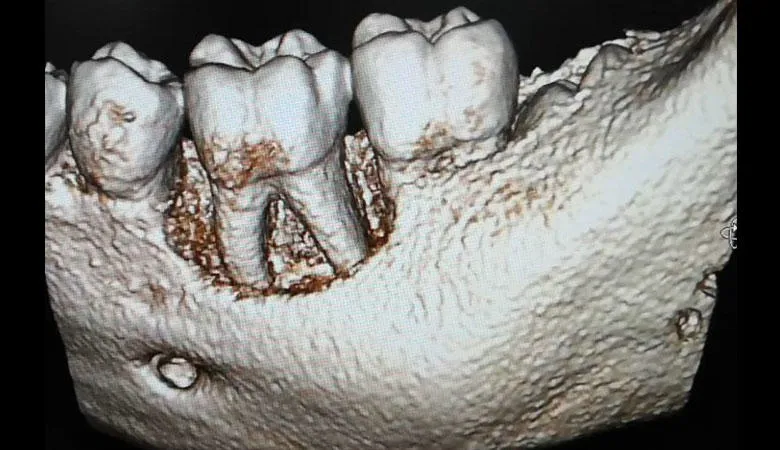 Mission: Research into periodontal and peri-implant diseases with the aim to improve patient care and quality of life. This is done by studying mechanisms of disease pathogenesis and interactions with systemic health, and by carrying out translational treatment studies, ranging from minimally-invasive treatment to tissue-engineering.