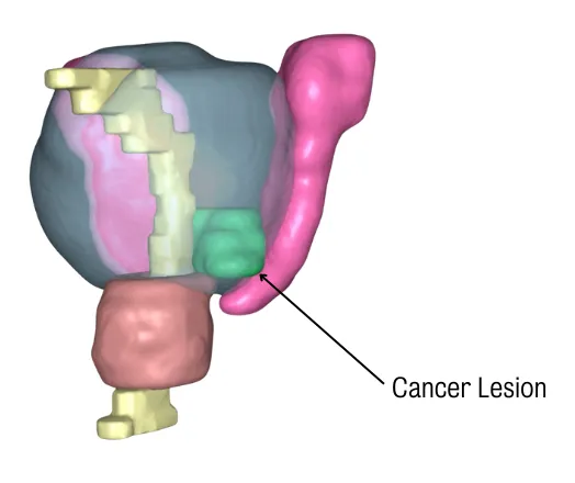 cancer lesion