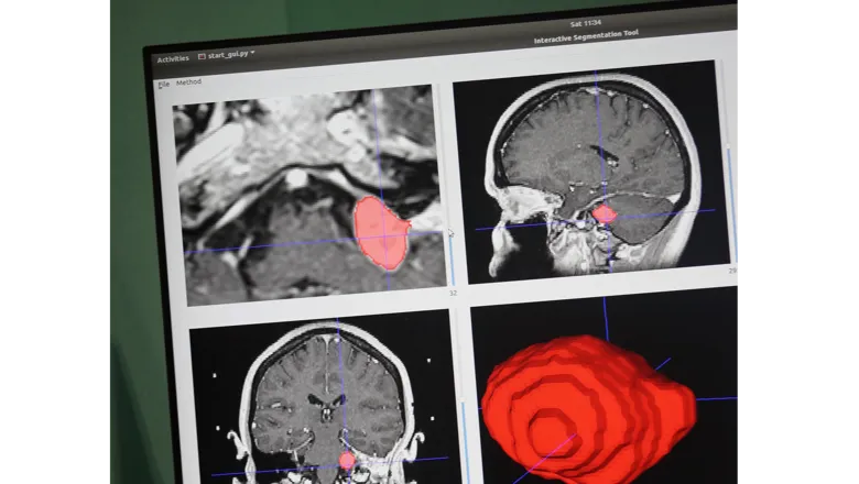 Tumour segmentation tool