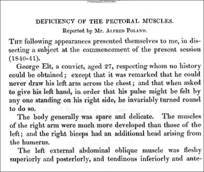 Deficiency of the pectal muscles