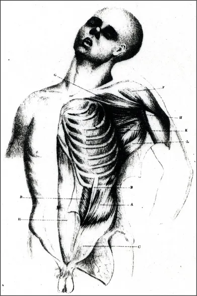 deformity of pectal muscles sketch