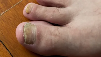 infected nail