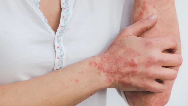 A person with psoriasis itching their arm.