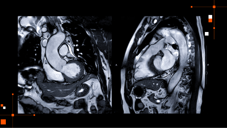 Two cardiac MRI scans displayed side-by-side on a black background