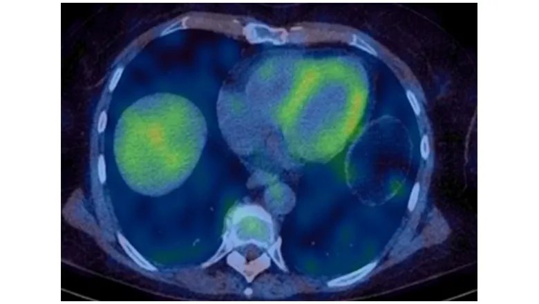 Myocarditis article image_2_V2