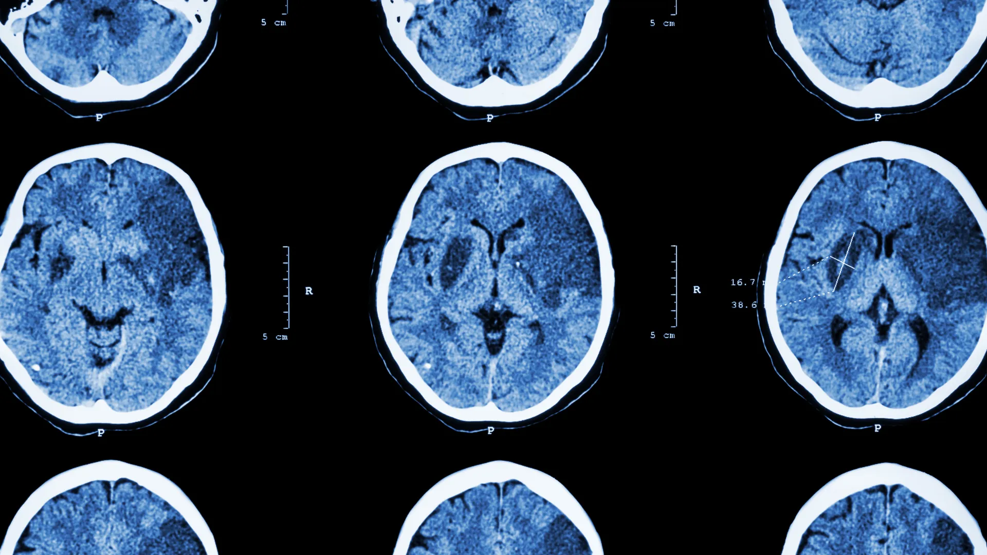 Ischemic Stroke