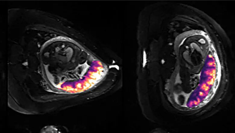 Colour-coded maps of perfusion through the placenta acquired first whilst the mother is on their back (right) and subsequently with the mother on their side (left).