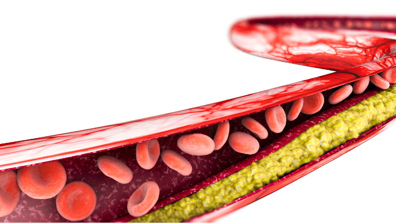 New Study Seeks To Improve Identification Of Inherited High Cholesterol   Cholesterol.x3f827e09 