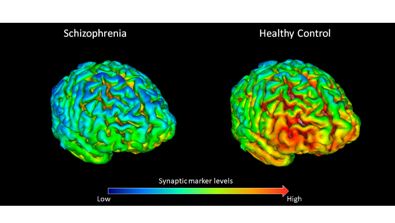 new research on schizophrenia