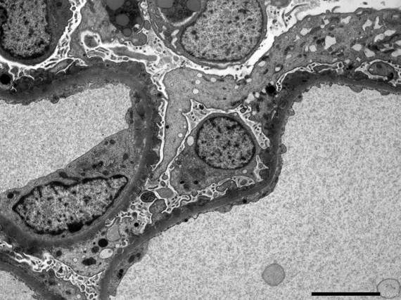 Renal biopsy